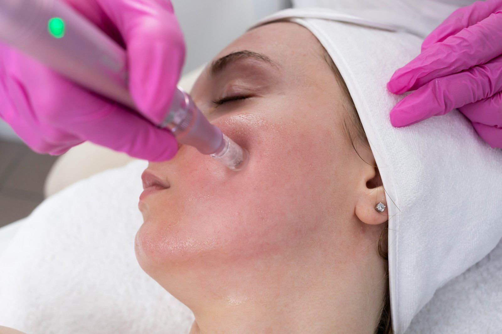 A close-up of a skin rejuvenation treatment on a patient's face (sample photo)