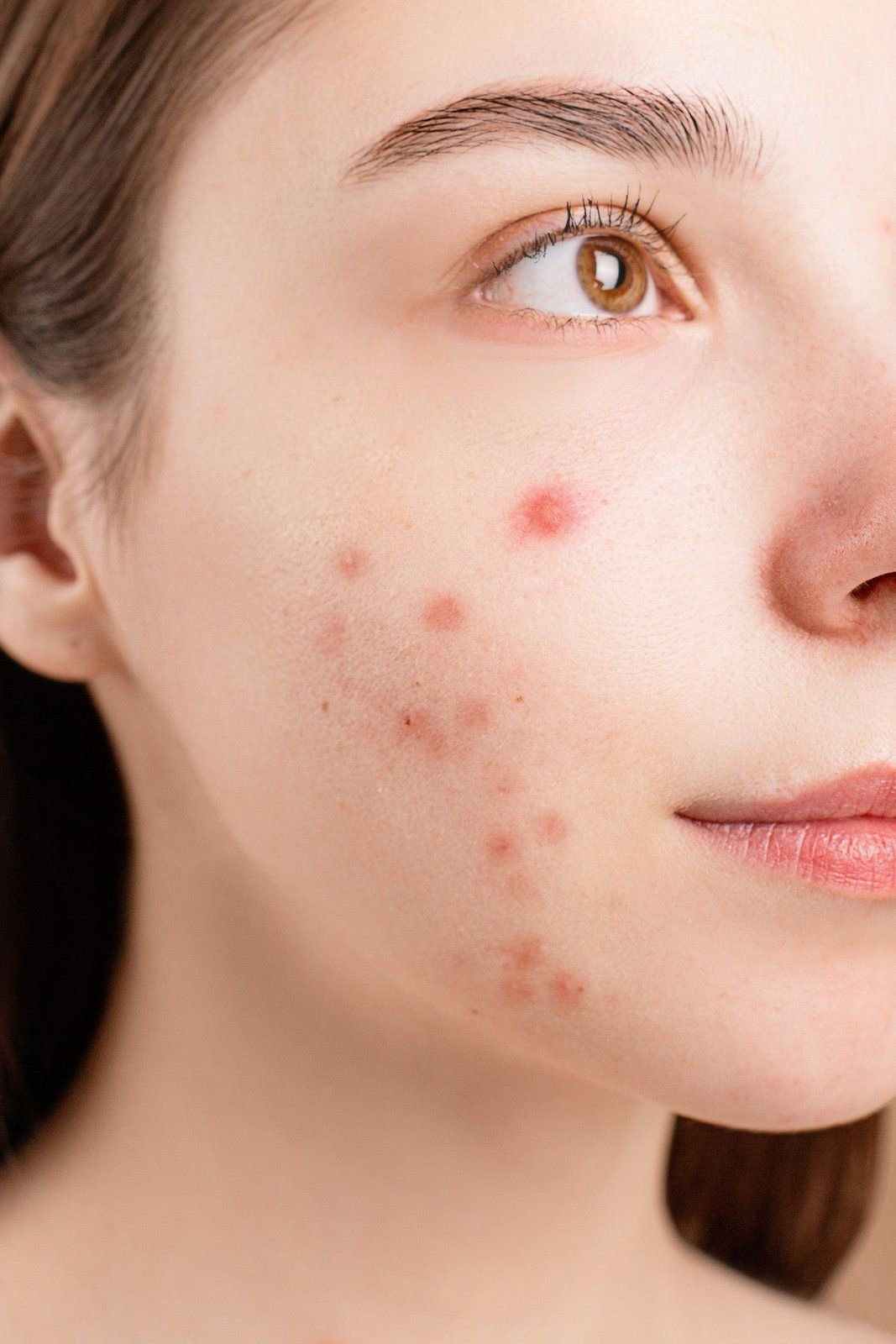 Close-up of acne-prone skin (sample photo)