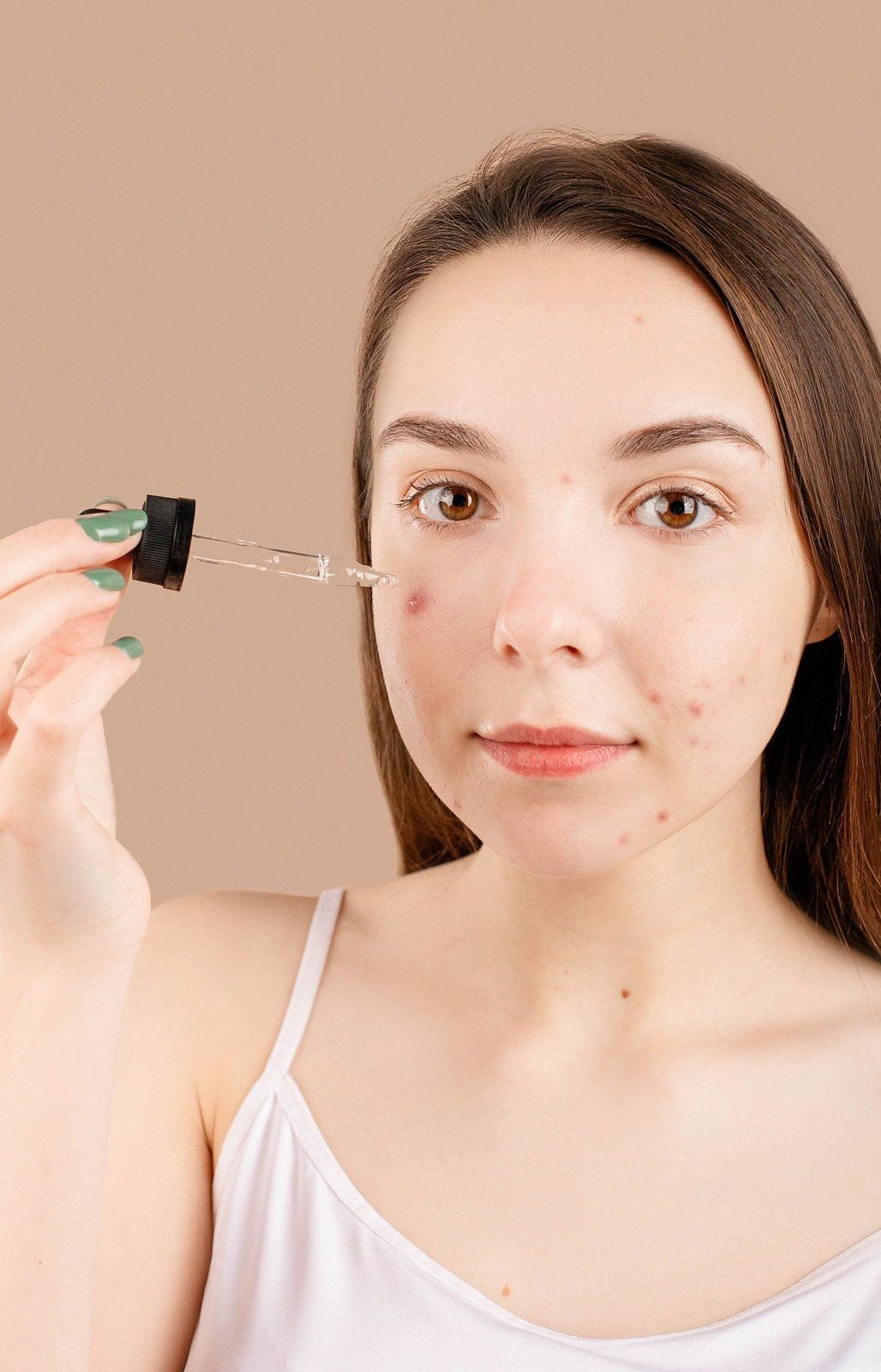 Girl with visible acne marks holding a dropper beside her face (sample photo)